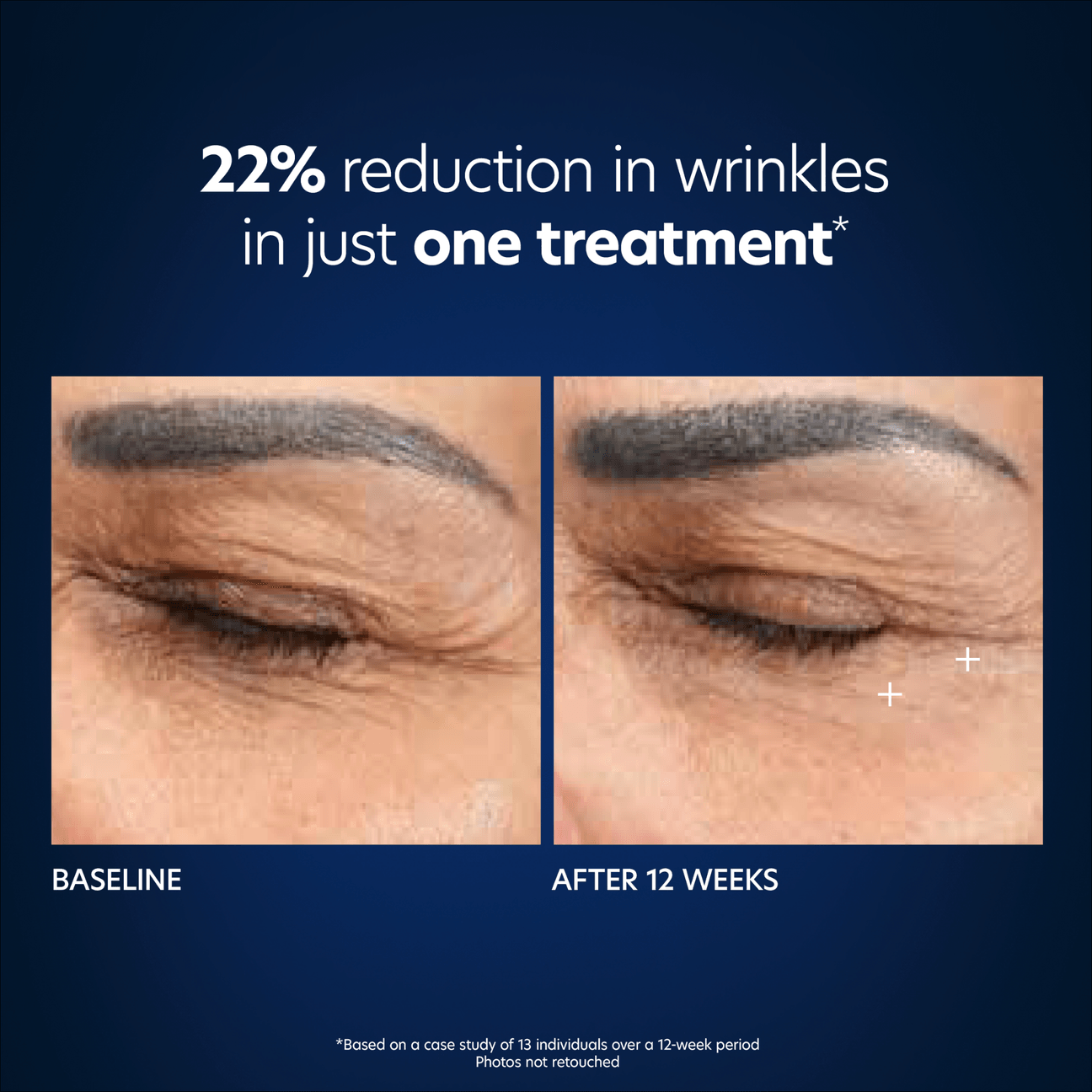 Hyaluronic Acid Microneedle Eye Patches (1 set)