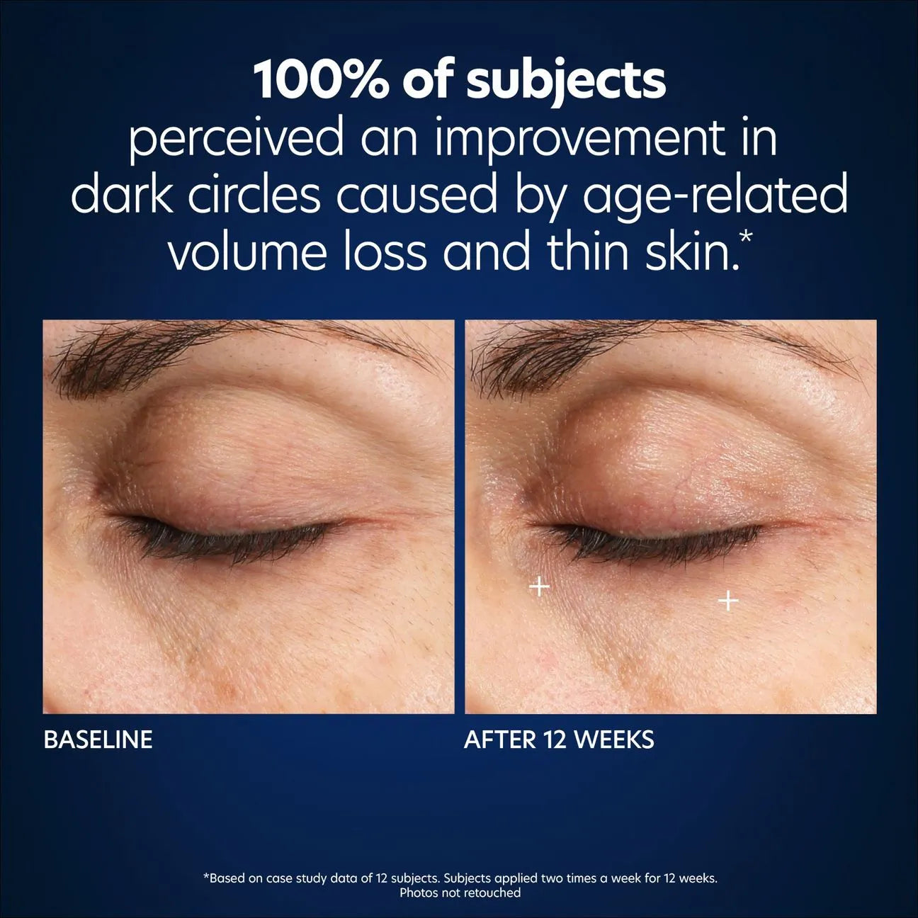 Hyaluronic Acid Microneedle Undereye Patches (pack of 4 sets)
