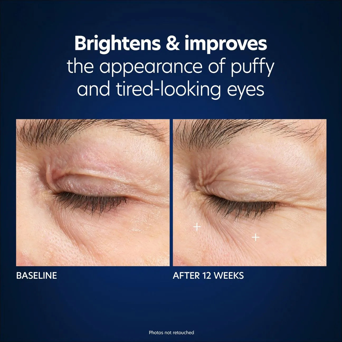 Hyaluronic Acid Microneedle Undereye Patches (pack of 4 sets)